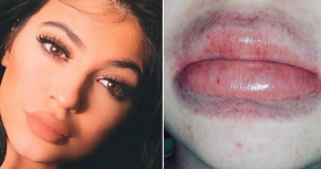 Kylie Jenner lip challenge