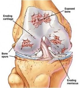 One in every two women suffers from low bone density 